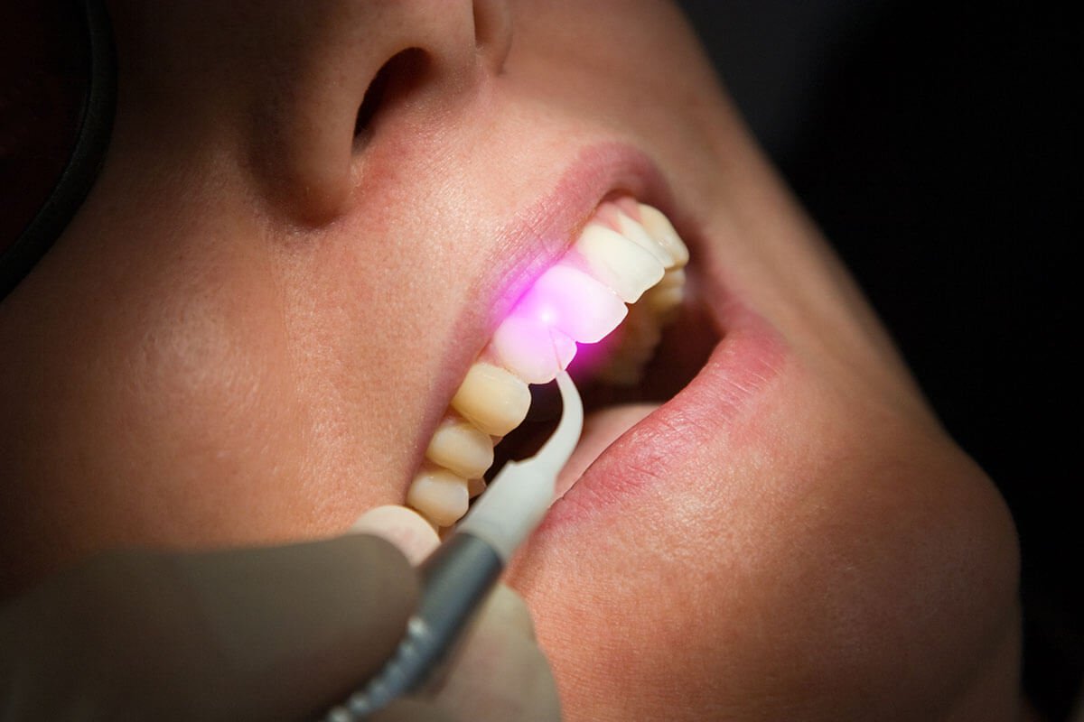 Laser Dentistry in Ahmedabad
